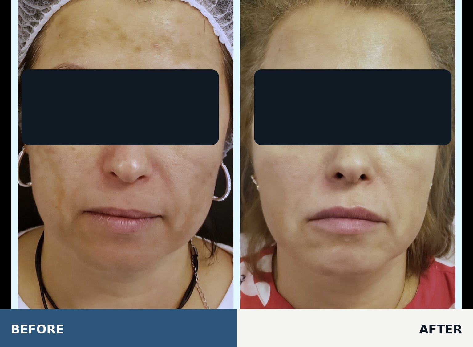 Carbon laser pigmentation result before and after, anonymized for privacy