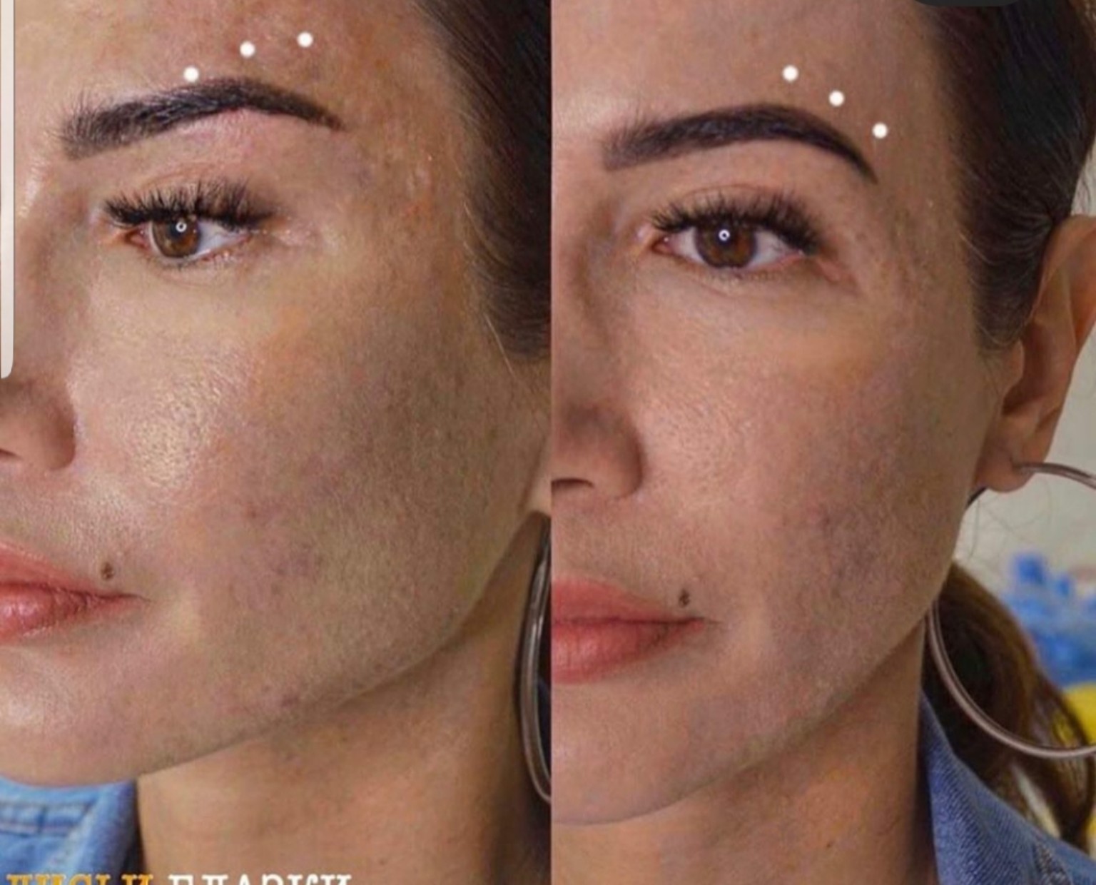 Thread Lift facial contour comparison